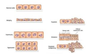 Module 1 : Introduction to Pathophysiology / Altered cell and tissue biology